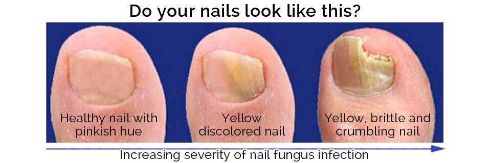 fungal-nail-infections