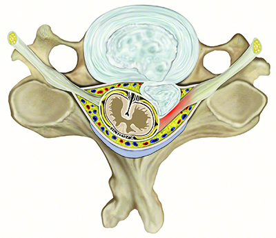 cervical-disc-prolapse