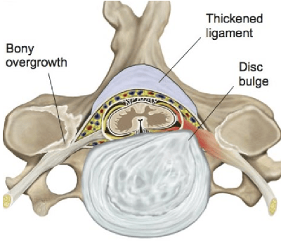 cervical-stenosis-and-cervical-myelopathy-new
